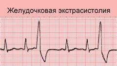 При назначении лечения экстрасистолии учитывают форму и локализацию заболевания